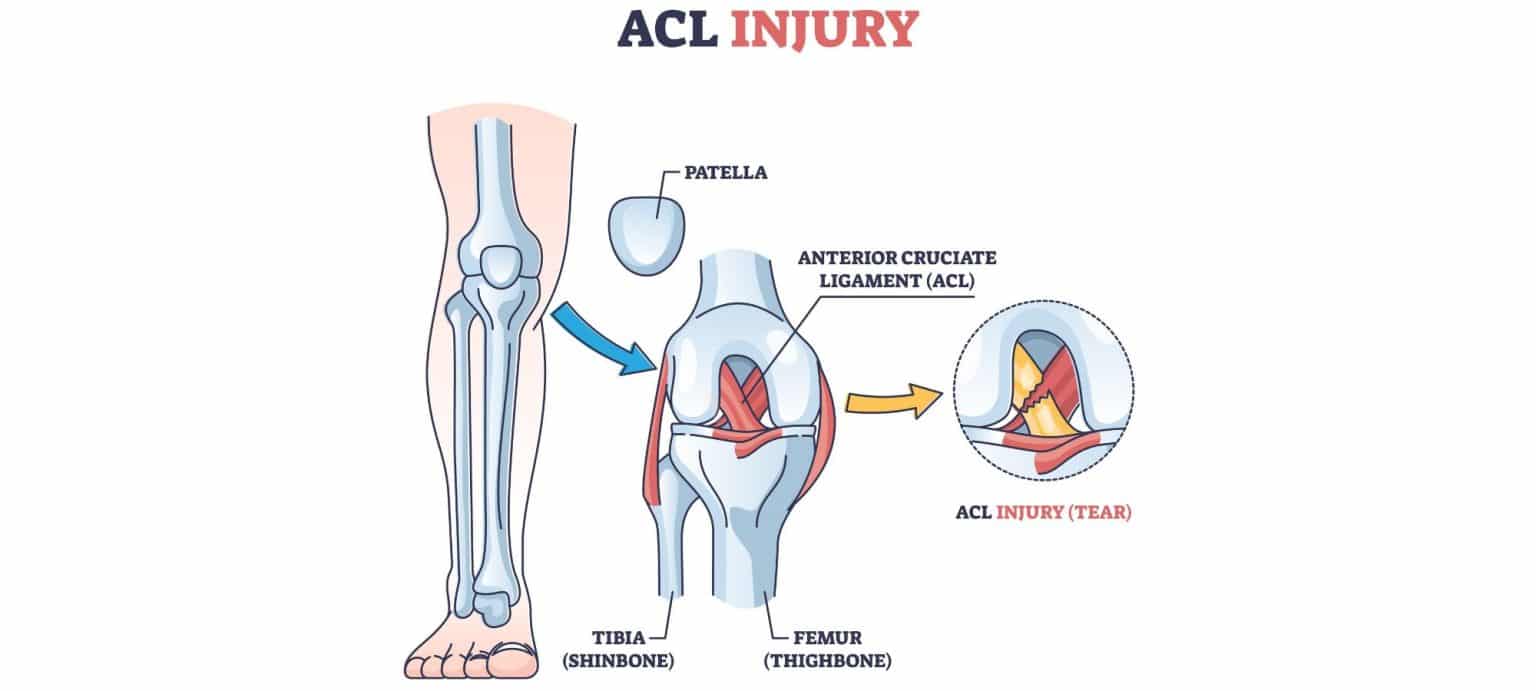 Understanding ACL Tears and Their Treatment Options