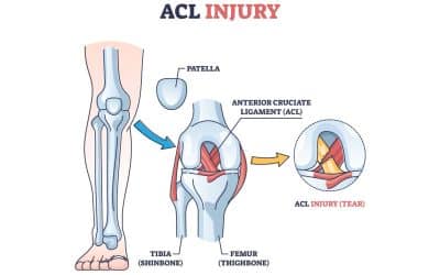 Understanding ACL Tears and Their Treatment Options