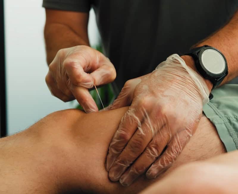 Physiotherapist performing acupuncture on a patient's knee for pain relief.
