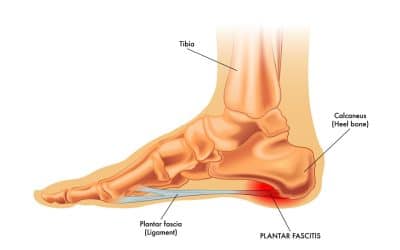 The Evidence Behind Orthotics and Insoles in Plantar Fasciitis Care and Prevention