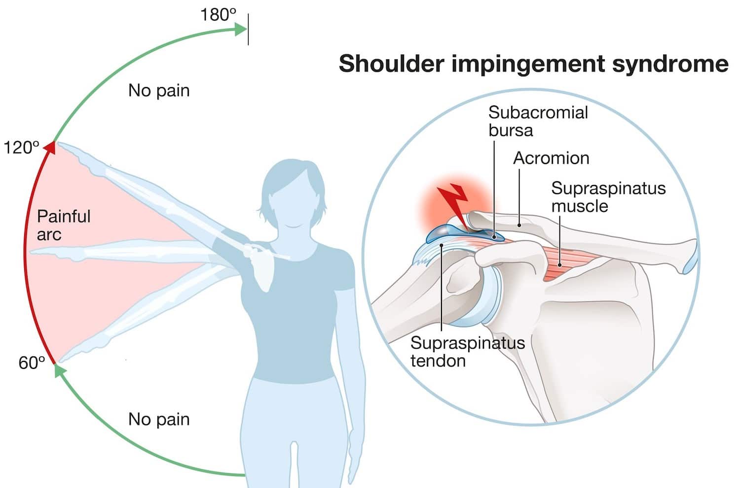 shoulder impingement syndrome