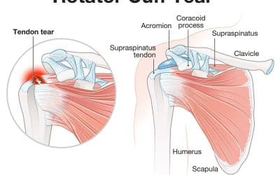 Torn Rotator Cuff – What Does It Mean?