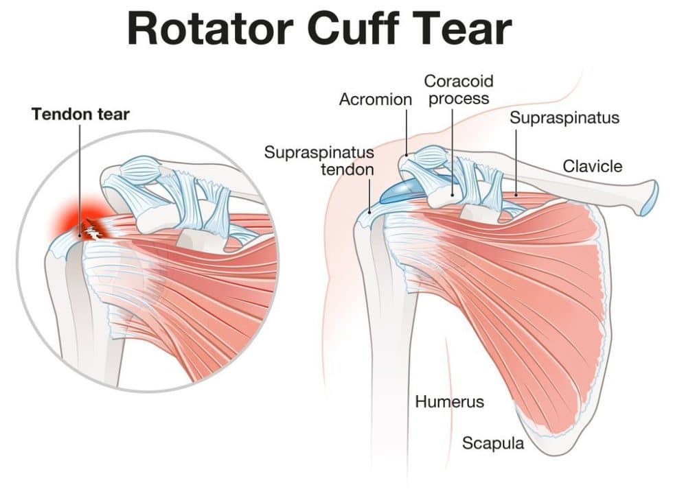 Torn Rotator Cuff: Everything You Need to Know